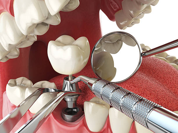 Best Emergency Tooth Extraction in Milford, NE